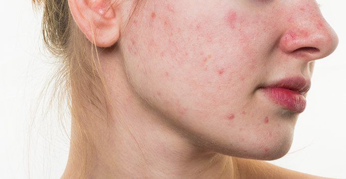 Rosacea: Subtypes, Symptoms, Causes, Diagnosis & Treatment