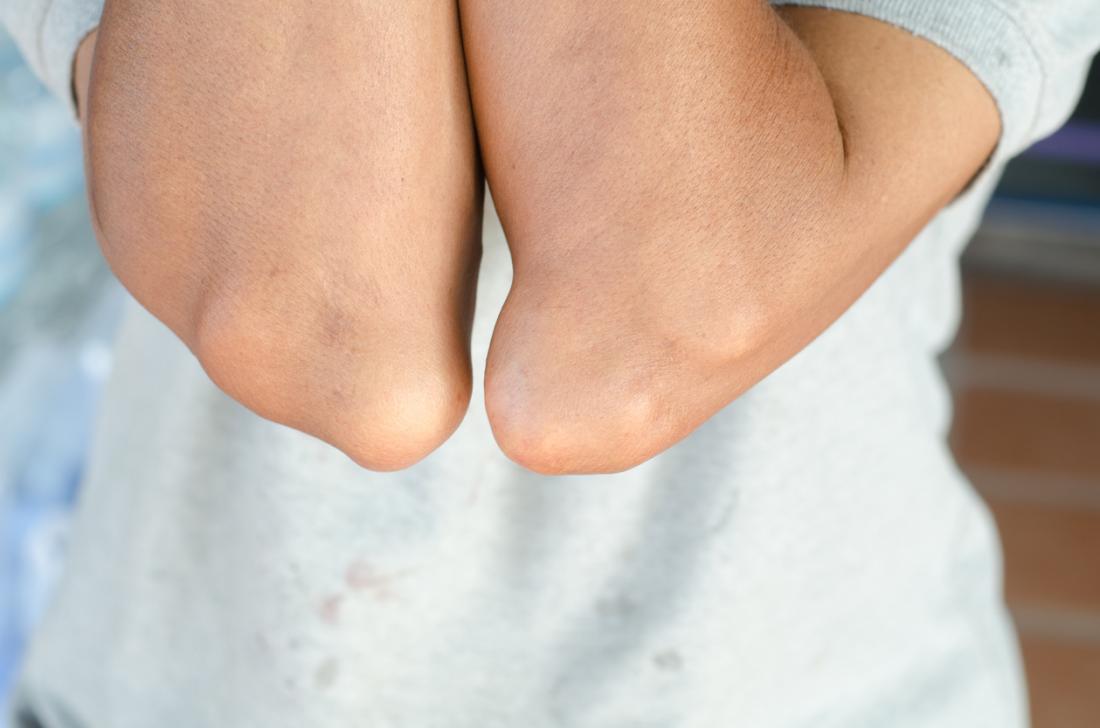 Gout Risk Factors, Symptoms, Complications, Diagnosis & Treatment