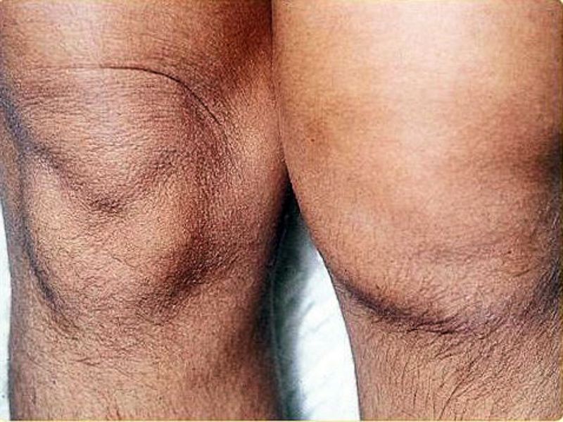 Reactive Arthritis (ReA) Causes, Symptoms, Diagnosis & Treatment