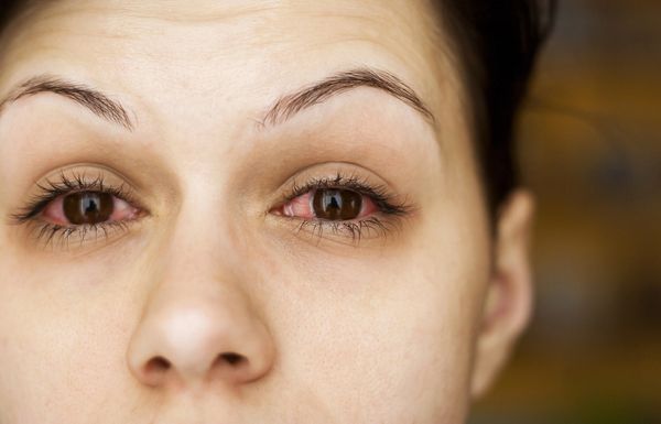 11 Best Treatments For Eye Allergy Relief