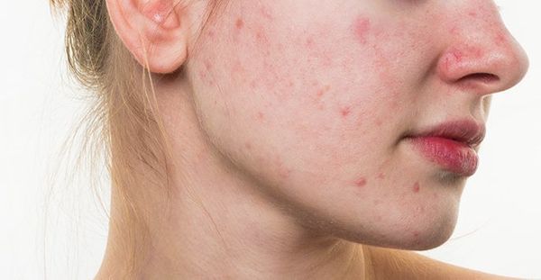Rosacea: Subtypes, Symptoms, Causes, Diagnosis & Treatment