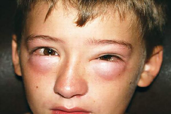 Anaphylaxis: Common Triggers, Symptoms, Prevention, Diagnosis & Treatment
