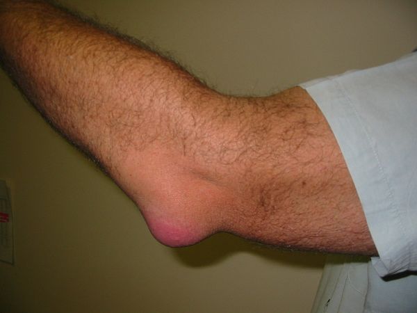 Bursitis Causes, Symptoms, Diagnosis & Treatment