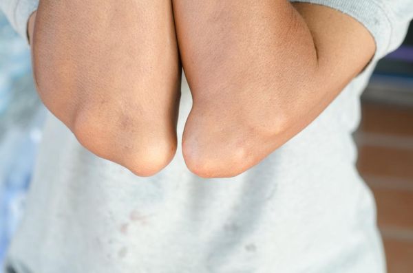Gout Risk Factors, Symptoms, Complications, Diagnosis & Treatment