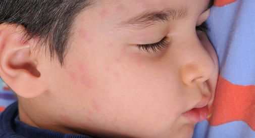 Hives (Urticaria): Triggers, Causes, Types, Symptoms, Diagnosis & Treatment