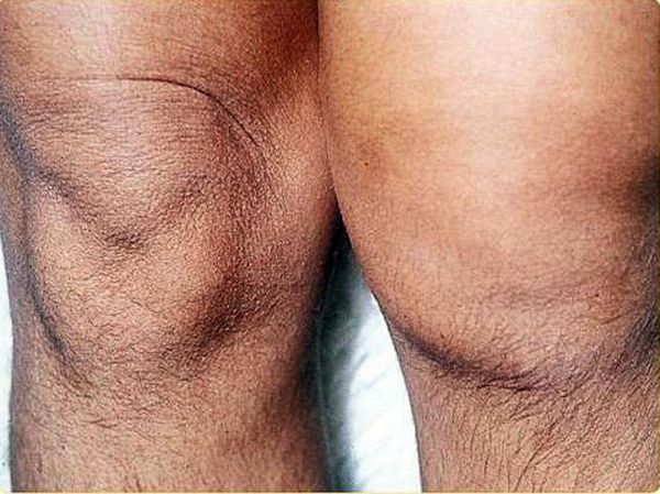 Reactive Arthritis (ReA) Causes, Symptoms, Diagnosis & Treatment