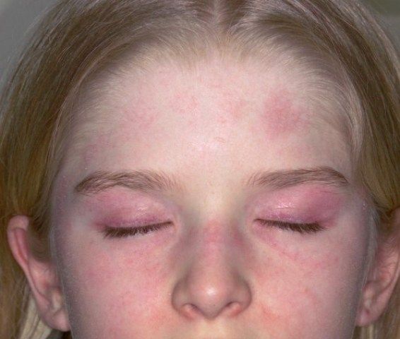 Juvenile Dermatomyositis (JDM) Symptoms, Causes, Diagnosis & Treatment