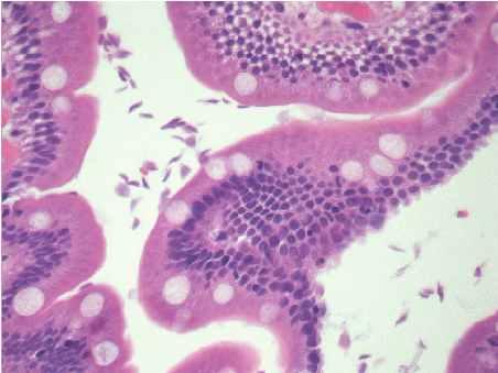 Giardiasis (Beaver Fever) Symptoms, Causes, Diagnosis & Treatment