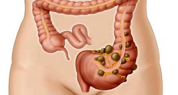 Irritable Bowel Syndrome (IBS) Causes, Symptoms, Diagnosis & Treatment