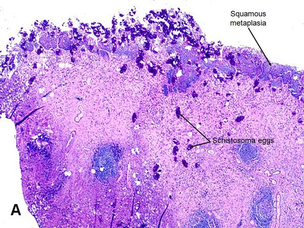 Schistosomiasis (Bilharzia) Causes, Symptoms, Diagnosis & Treatment