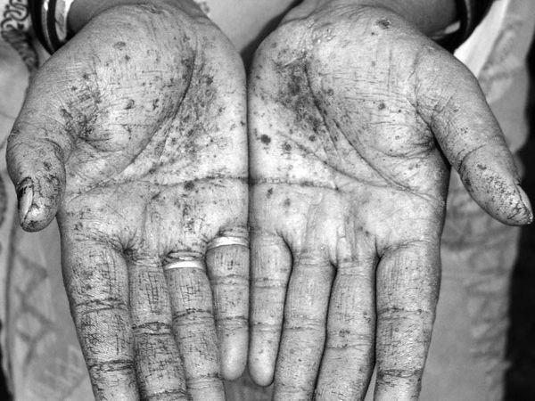 Arsenicosis Causes, Symptoms, Diagnosis, Treatment & Preventions