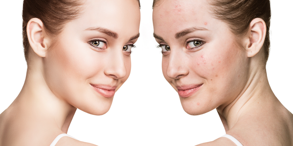 4 Scientifically Proven Forms Of Anti-Androgens That Keep Acne At Bay