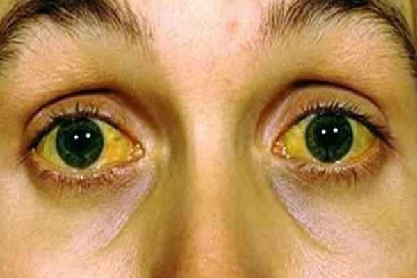 Jaundice (Icterus) Types, Causes, Symptoms, Diagnosis, Treatment & Prevention